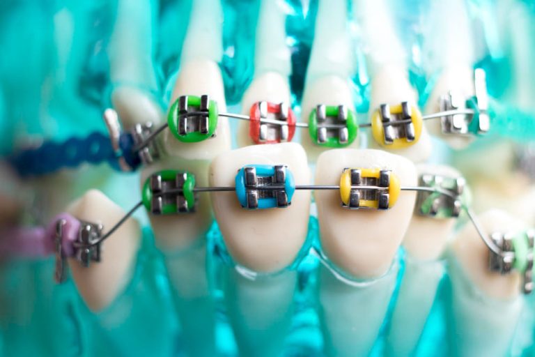 ortodoncia de colores